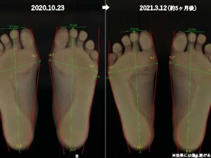 外反母趾の原因は遺伝と思っていませんか？「親も外反母趾」なのに改善した羽曳野市の30代女性の事例